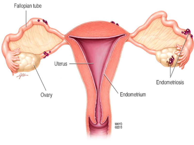 Portada endometriosis
