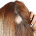 Caída del cabello y Alopecia: un problema de salud y estético
