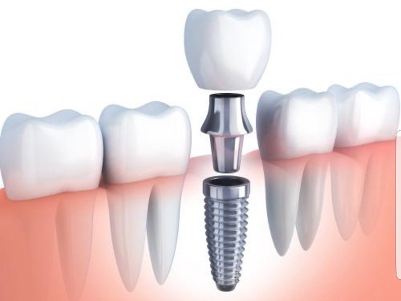 Portada Tipos de prótesis dentales